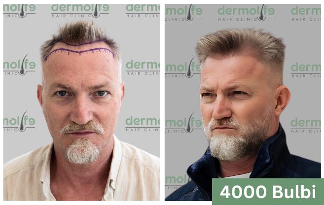 Trapianto di capelli prima e dopo 11