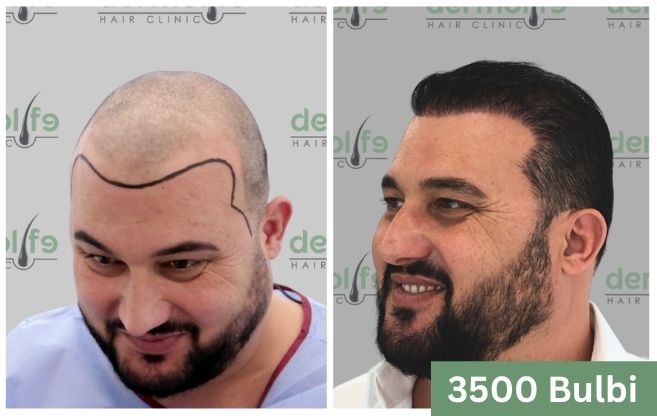 Trapianto di capelli prima e dopo 14