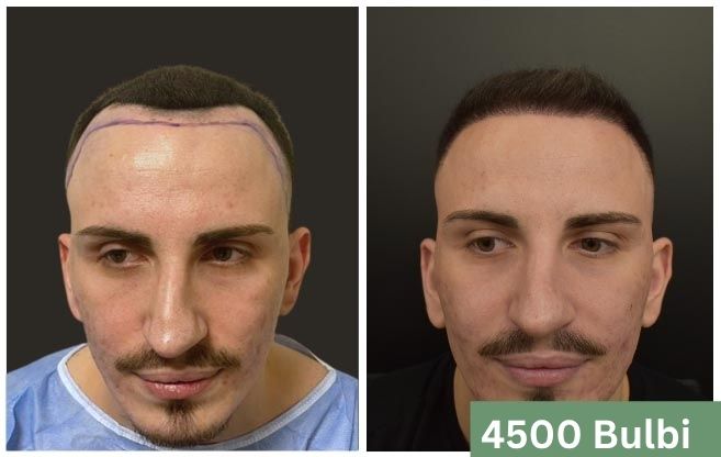 Trapianto di capelli prima e dopo 17