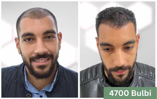 Trapianto di capelli prima e dopo 19
