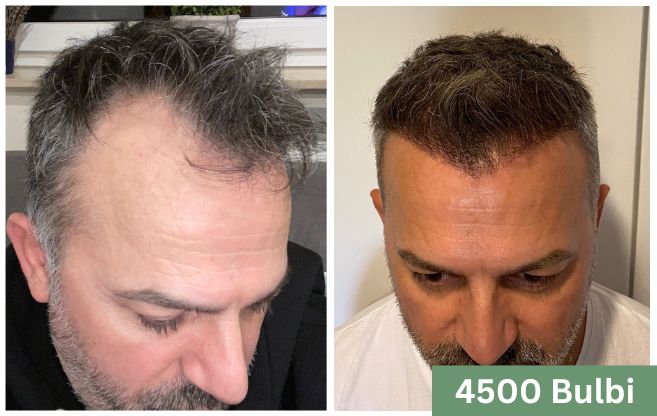 Trapianto di capelli prima e dopo 3