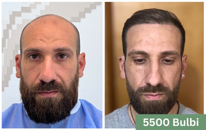 Trapianto di capelli prima e dopo 4