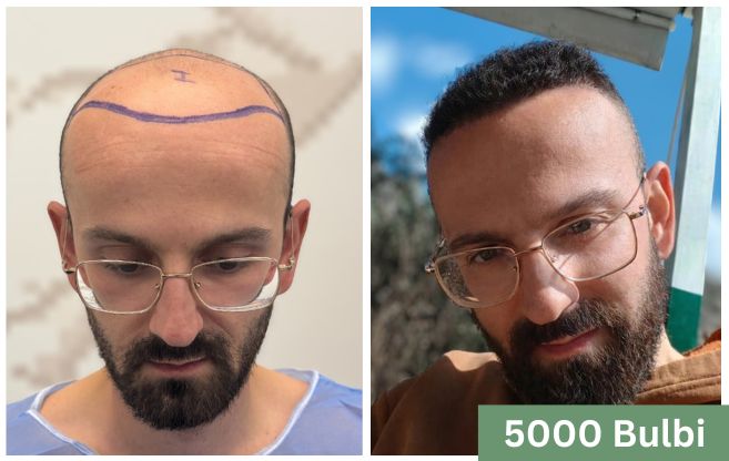 Trapianto di capelli prima e dopo 5