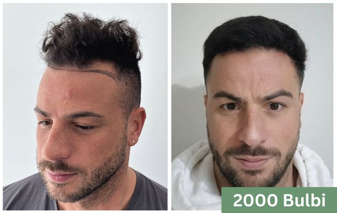 Trapianto di capelli prima e dopo 6