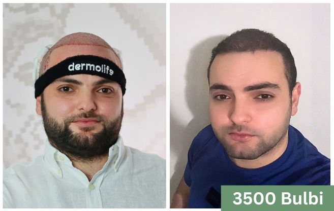 Trapianto di capelli prima e dopo 8