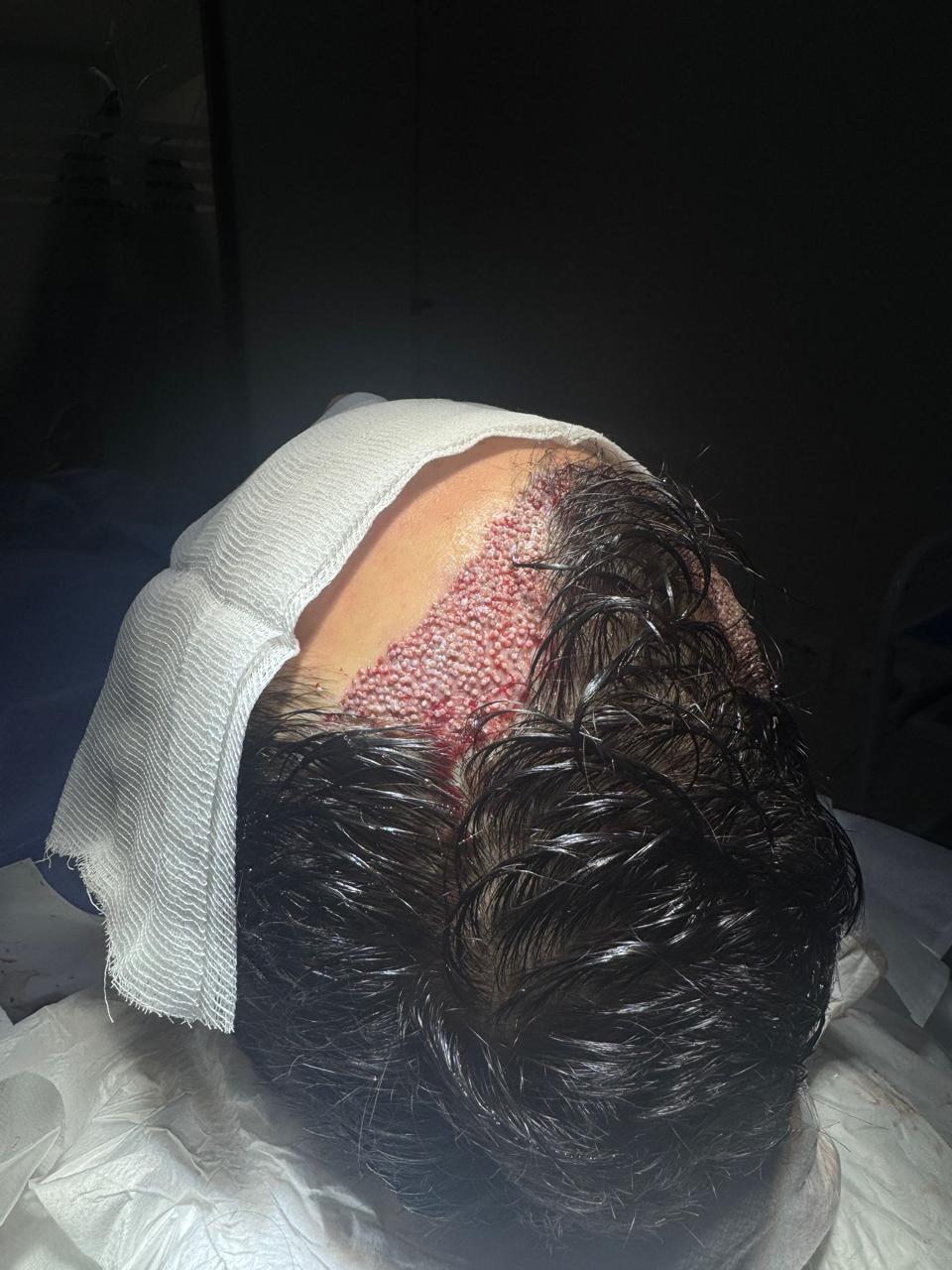 Metoda DHI për transplantin e flokëve