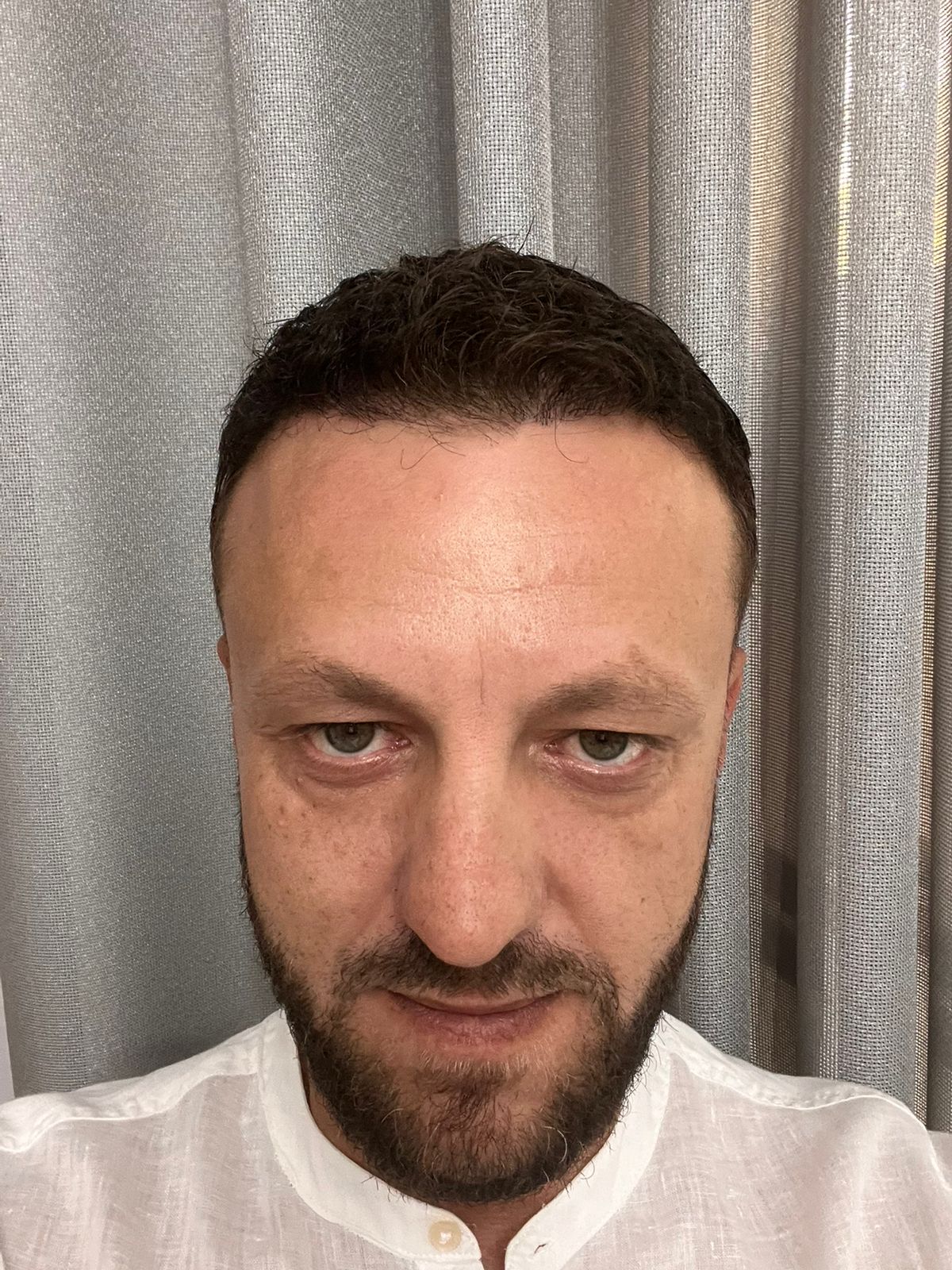 12 muaj pas transplantit të flokëve