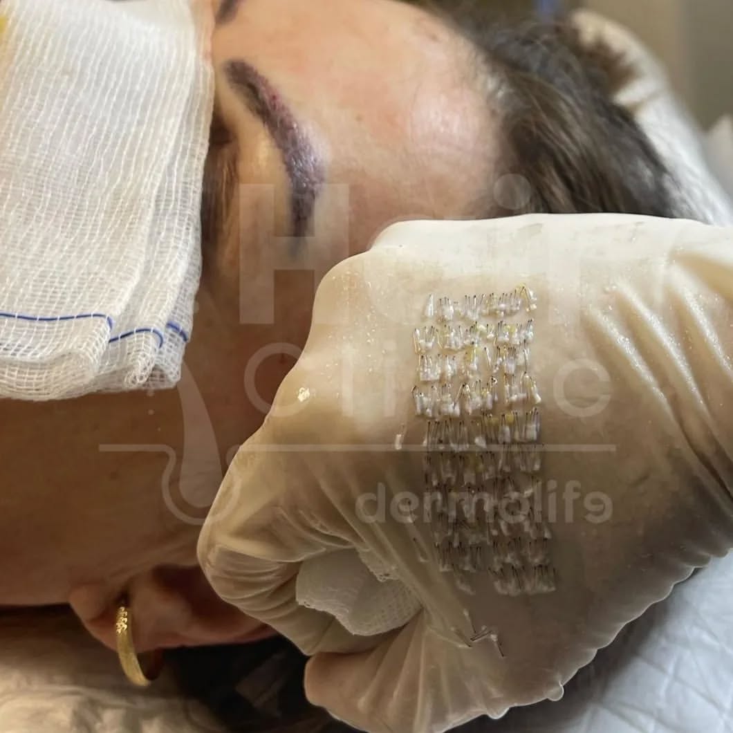 Rezultatet e transplantit të vetullave